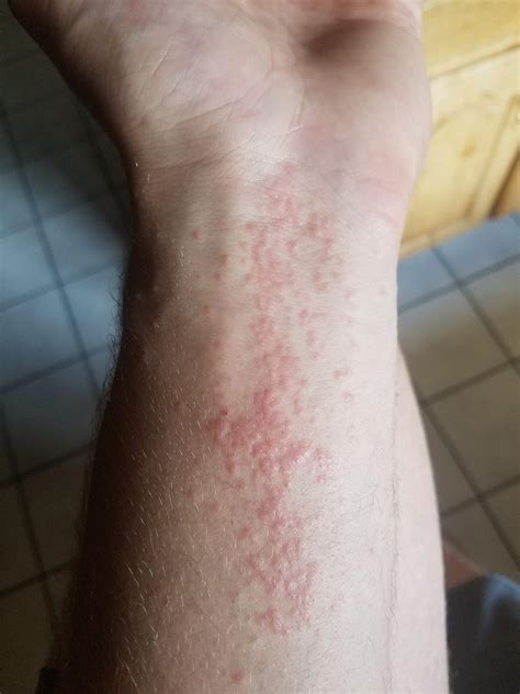 Have A Persistent Rash On My Left Forearm Any Ideas Or Should I Visit