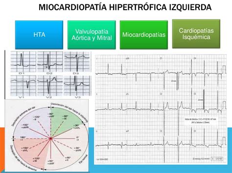 Hipertrofia Ventricular Electrocardiograma