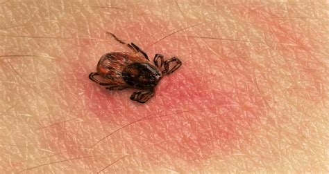How To Check The Body For Ticks And How To Properly Get Rid Of Them