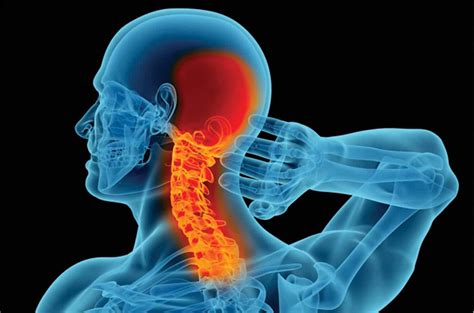 CERVICAL SPINE NECK PAIN WHAT YOU SHOULD KNOW ABOUT THE CAUSE AND YOUR TREATMENT OPTIONS
