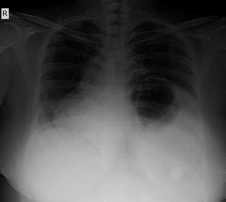 Diaphragmatic Rupture Radiology Reference Article Radiopaedia Org