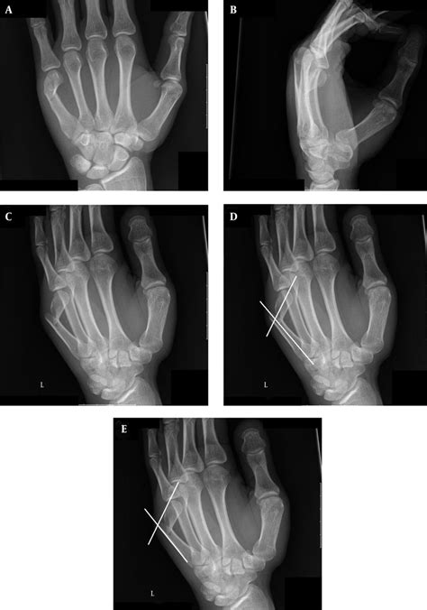 Radiographic Assessment Of Metacarpal Neck Fractures Note The Dorsal