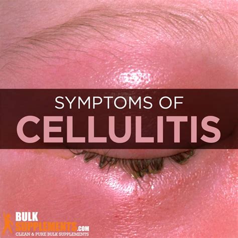Cellulitis Symptoms Causes Treatment