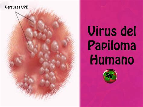 Epidemiología molecular y análisis filogenético de la infección por el virus del papiloma humano