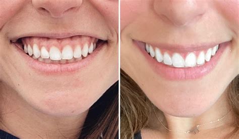 Treating A Gummy Smile With Botox The Daily Glimmer