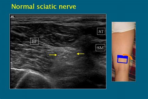 Peripheral Nerve Lesions Role Of High Resolution Us Radiographics