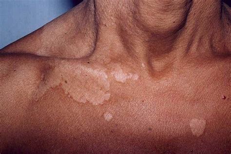 Tinea Versicolor Treatment Pictures Causes Symptoms Prevention