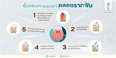 การรักษาคลองรากฟัน คือการกำจัดเชื้อจุลชีพที่อยู่ในโพรงประสาทฟันที่มีการ