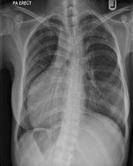 In situs inversus totalis (with dextrocardia), all of the visceral organs are located in the opposite side of the body in mirror reflection of their normal. Malaysian Family Physicians - An adult patient with ...
