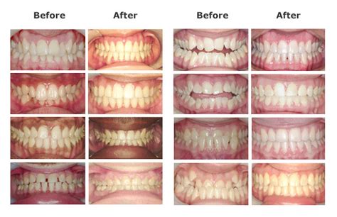 How Long Does It Take For Ceramic Braces To Work Diastema Or Gaps