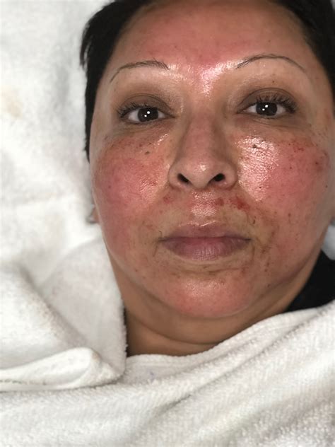 Get the most out of your treatment microneedling and the vampire facial. ANDE LIKES: MICRONEEDLING - The Beauty Blog