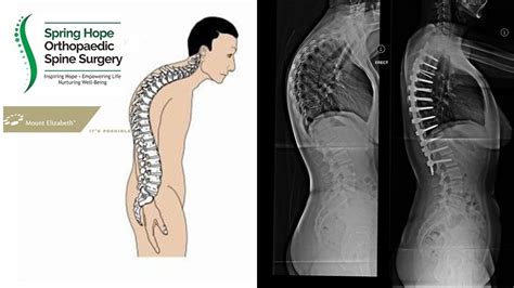 Kyphosis Orthopaedic Spine Surgery Singapore