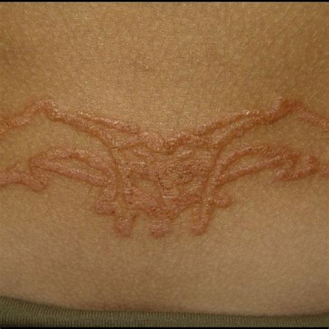 Eczema Over A Henna Tattoo The Limits Of The Eczema Are Marked By The