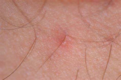 Chiggers Everything You Need To Identify Control And Get Rid Of Them