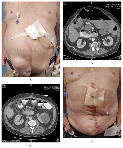 Operative Management Of Massive Hernias With Associated Distended Bowel
