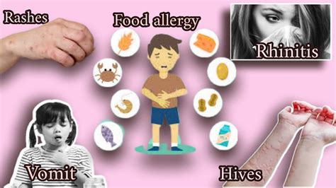 Allergy Its Cause Symptom Treatment Hives Skin Allergy Food