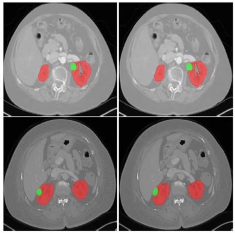 J Imaging Free Full Text Kidney Tumor Semantic Segmentation Using