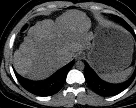 Liver Cirrhosis Ct Scan