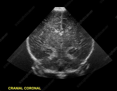 Neonatal Transcranial Ultrasound Stock Image C0271647 Science
