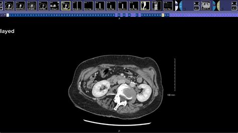 How To Read A Pancreas Ct Youtube