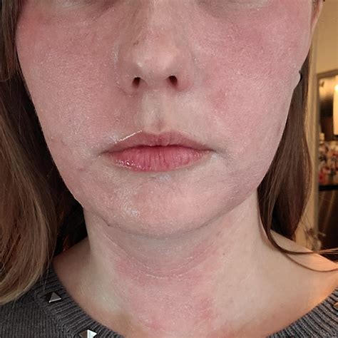 Have I Damaged My Moisture Barrier Routine In Comments Rtretinoin