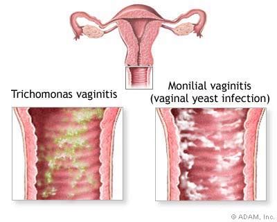 The New York Times Health Image Causes Of Vaginal Itching