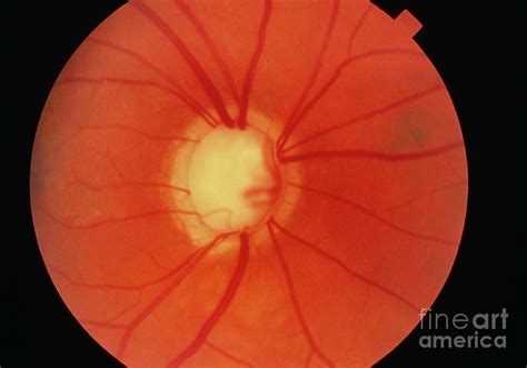 Fundus Camera Image Cupping Of Disc In Glaucoma Photograph By Western