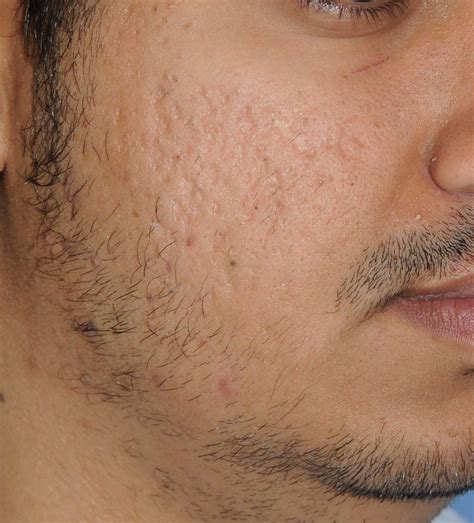 Acne Scar Vitalizer Treatment Seattle And Bellevue