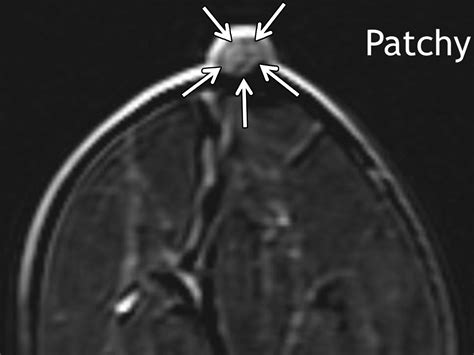 An Analysis Of Nipple Enhancement At Breast Mri With Radiologic