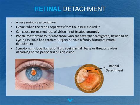 The Most Common Retinal Diseases