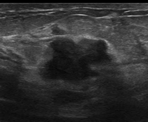 Ultrasonography Shows An Irregular Hypoechoic Mass Of 23 Mm In