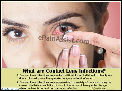 Contact Lens Infectioncausessymptomstreatmenthome Remediesprevention