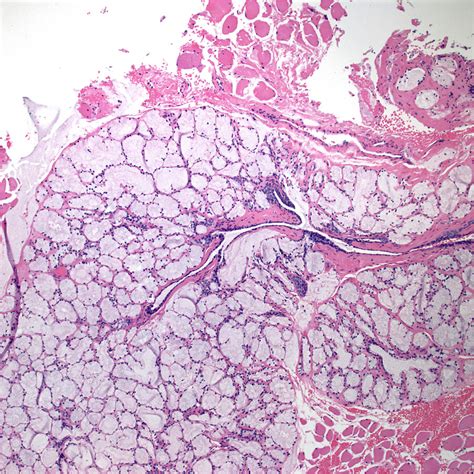 Pathology Outlines Cowper Glands