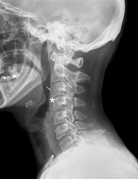 This can occur at the ligament by the application of forces external to the body (such as a fall or pull). -Avulsion fracture of the C3 vertebral body. This patient ...