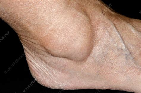 Ganglion Over The Ankle Stock Image C Science Photo Library