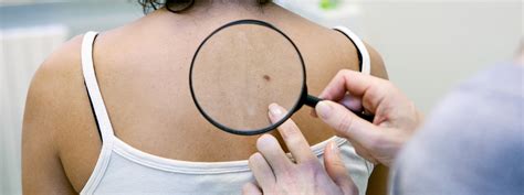 Skin Cancer Screening Orchard Park Ny Cancer Prevention Dr Peter