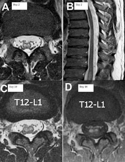 Conus Medullaris Stroke Neurosciences Journal