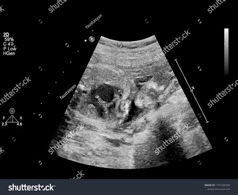 Ultrasound Screen Fetal Echocardiography Stock Photo Edit Now 1741560785