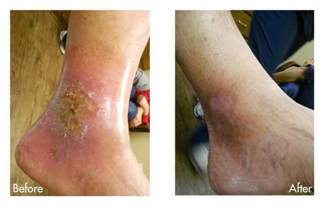 Receive Treatment For Venous Ulcers In Houston Tx Txvein