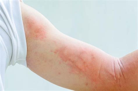 Skin Cancer Rash On Arm Sun Safety Spotting Skin Cancer 5min 25sec