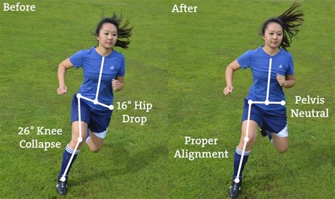 Who Needs Knees Why Acl Injury Prevention Matters Stride Physio