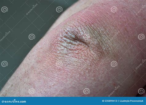 Close Up Dry Flaky Skin On Elbow Caused By Psoriasis Stock Image