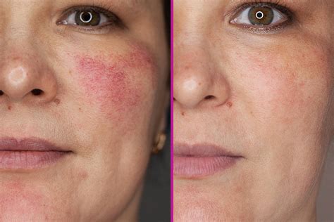 Rosacea The Ins And Outs And How To Treat This Skin Condition Tash360