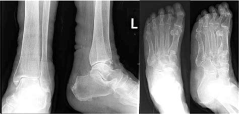 Radiographs Of A Patient Who Presented With Multiple Foot Abscesses