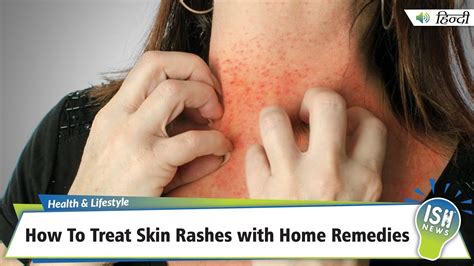 How To Treat Skin Rashes With Home Remedies Ish News Youtube