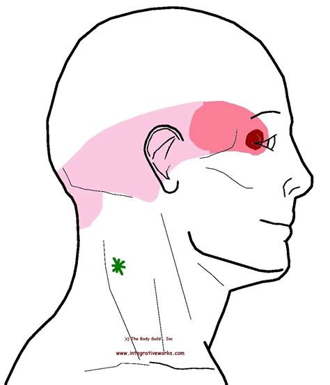 Neck Ache Headache Eye Ache Trigger Points Neck Ache Trigger