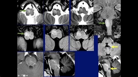 Imaging The Brainstem Tracts Part 3 Sept 16 2015