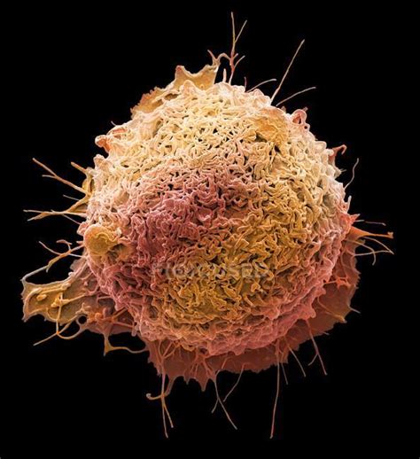 Coloured Scanning Electron Micrograph Of Cancer Cell From Human Colon