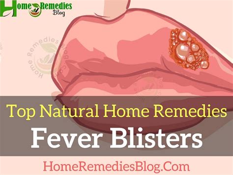 how to get rid of fever blisters effectively complete guide home remedies blog