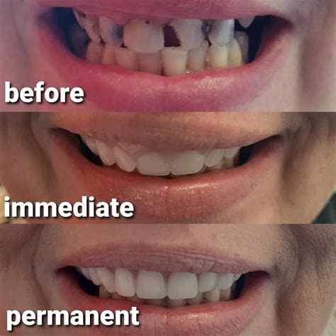 Denturepoint Denture Clinic In Mornington 2h Denture Repairs All